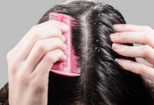 Photo of बालों से डैंड्रफ हटाने के लिए दही का इस्तेमाल काफी फायदेमंद साबित होगा, जानें दही से डैंड्रफ कैसे हटाएं –
