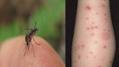 Photo of अगर आप भी मच्छर काटने के लाल निशान समस्या से है परेशान तो इन उपायों को अपनाए..