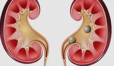 Photo of क्या आपको भी है किडनी स्टोन के दोबारा लौटने का डर?