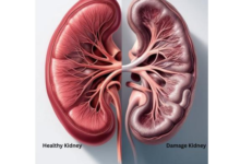 Photo of दोनों किडनी खराब होने के क्या संकेत हैं? जानिए Kidney Failure के शुरुआती लक्षण और बचाव के जरूरी उपाय